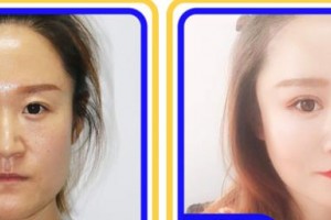 上海?，斎鹨曆劭漆t(yī)院張偉英整形價(jià)格表附眼部綜合案例展示