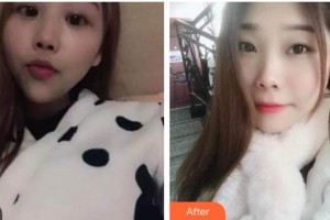 上海匯尚口腔門診部莊龍飛整形價(jià)格表附自鎖托槽矯正案例展示