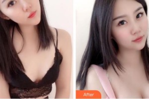 成都藝星醫(yī)療美容醫(yī)院劉曉榮整形價(jià)格表附濃縮豐胸真實(shí)案例展示