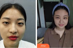 成都西區(qū)醫(yī)院醫(yī)學(xué)美容科瑪麗整形價(jià)格表附眉毛不上揚(yáng)案例展示