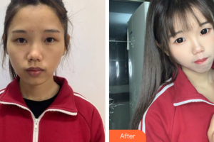 廣州廣美整形美容醫(yī)院王國(guó)權(quán)整形價(jià)格表附面部吸脂案例展示