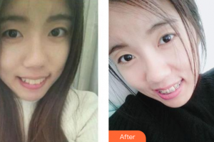 廣州華美醫(yī)療美容醫(yī)院張毓整形價(jià)格表附金屬托槽矯正案例展示