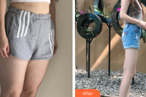 廣州華美醫(yī)療美容醫(yī)院郝永生整形價(jià)格表附吸脂瘦大腿案例展示