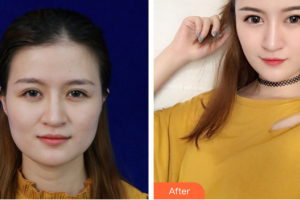 廣州曙光醫(yī)學(xué)美容醫(yī)院王娟整形價(jià)格表附面部吸脂案例展示