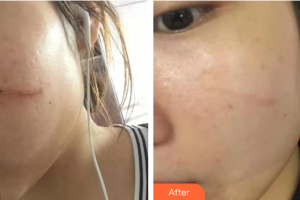 廣州時(shí)光整形美容醫(yī)院林麗娜整形價(jià)格表附點(diǎn)陣祛疤痕案例展示