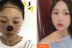 廣州荔醫(yī)醫(yī)療美容門診部何凱強(qiáng)整形價(jià)格表附發(fā)際線案例展示