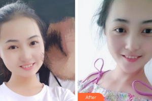 廣州華美醫(yī)療美容醫(yī)院肖海云整形價(jià)格表附冷光美白案例展示