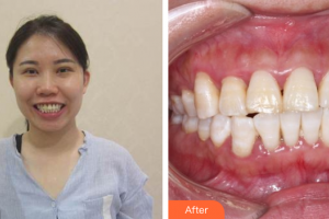 廣州華美醫(yī)療美容醫(yī)院李可君整形價(jià)格表附牙齒矯正案例展示