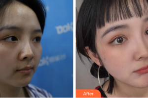廣州美恩整形美容醫(yī)院鄒麗莉整形價(jià)格表附眼部綜合案例展示