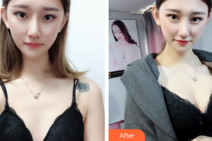 廣州市紅十字會(huì)醫(yī)院燒傷整形科謝有富整形價(jià)格表附自體脂肪隆胸案例展示