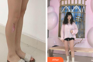 廣州市紅十字會(huì)醫(yī)院燒傷整形科梁岷整形價(jià)格表附增生疤痕案例展示