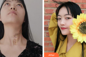 廣州市紅十字會(huì)醫(yī)院燒傷整形科李孝建整形價(jià)格表附燙傷疤痕修復(fù)案例展示