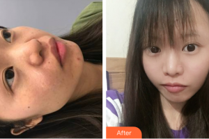 廣州市紅十字會(huì)醫(yī)院燒傷整形科梁達(dá)榮整形價(jià)格表附面部疤痕去除案例展示