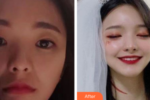 廣州南珠醫(yī)療美容門(mén)診部張瑤整形價(jià)格表附嫩膚美白案例展示