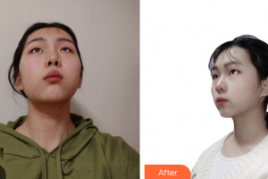 廣州博仕整形美容醫(yī)院青莉整形價(jià)格表附光子嫩膚案例展示