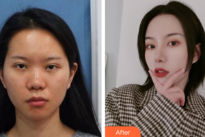 廣州南珠醫(yī)療美容門(mén)診部黃文博整形價(jià)格表附鼻部整形案例展示