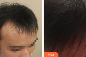 廣州新發(fā)現(xiàn)植發(fā)連鎖機(jī)構(gòu)吳安利整形價(jià)格表附種植發(fā)際線案例展示