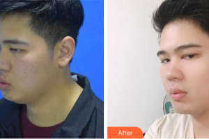 廣州韓妃醫(yī)學(xué)美容醫(yī)院金炫秀整形價(jià)格表附縮脂針案例展示