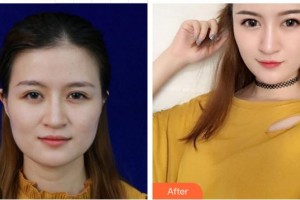 成都風(fēng)尚格致醫(yī)學(xué)美容整形醫(yī)院鄧朝東整形價(jià)格表附白竹案例展示