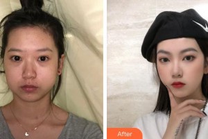 成都美容整形醫(yī)院馮春雨整形價(jià)格表附下頜角磨骨案例展示