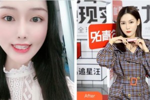 成都漢密爾頓美容醫(yī)院鄧典智整形價(jià)格表附隱形矯正案例展示