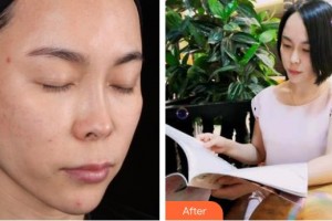 成都少城醫(yī)院醫(yī)療美容科朱天申整形價(jià)格表附多方面部埋線提升案例展示