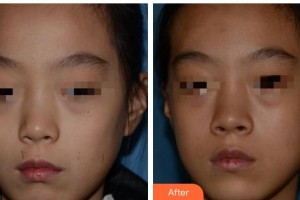 成都漢密爾頓美容醫(yī)院穆赫蘭整形價(jià)格表附激光點(diǎn)痣案例展示