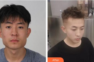 成都少城醫(yī)院醫(yī)療美容科崔熙允（CHOI HEE YOUN）教授整形價(jià)格表附頜面整形案例展示