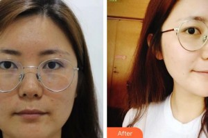 成都米蘭柏羽醫(yī)學(xué)美容醫(yī)院鄒景貴整形價(jià)格表附面部吸脂案例展示