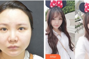 成都名府整形外科門診部楊漢城整形價(jià)格表附面部溶脂案例展示