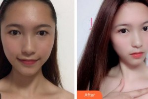 成都少城醫(yī)院植發(fā)科程宗玉整形價(jià)格表附發(fā)際線案例展示