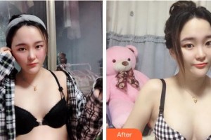 成都藝星醫(yī)療美容醫(yī)院周鵬起整形價(jià)格表附濃縮豐胸真實(shí)案例展示