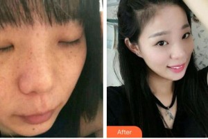 成都華西保健醫(yī)院整形美容中心馬德強(qiáng)整形價(jià)格表附雙機(jī)祛斑案例展示