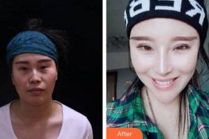 成都華西保健醫(yī)院整形美容中心馬樹林整形價(jià)格表附鼻部手術(shù)案例展示