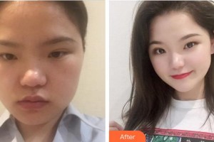 成都華西保健醫(yī)院整形美容中心李凱整形價(jià)格表附隆鼻案例展示