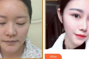 成都華西保健醫(yī)院整形美容中心王先松整形價(jià)格表附鼻部多項(xiàng)案例展示