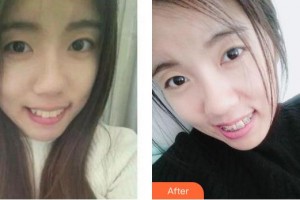 成都漢密爾頓美容醫(yī)院武剛整形價(jià)格表附金屬托槽矯正案例展示