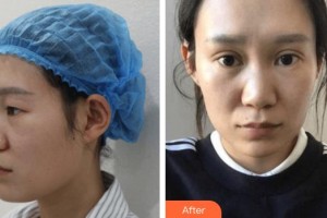 成都漢密爾頓美容醫(yī)院陳亮整形價(jià)格表附雙眼皮案例展示