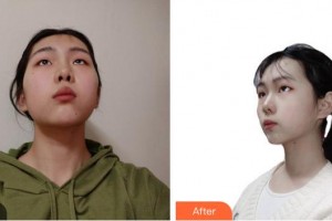 成都漢密爾頓美容醫(yī)院Bitter整形價(jià)格表附光子嫩膚案例展示