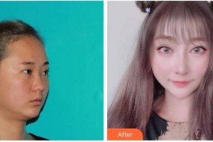 成都華西保健醫(yī)院整形美容中心陳芳整形價(jià)格表附鼻部整形案例展示