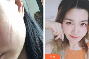 成都美立方（原華博）醫(yī)療美容醫(yī)院姚波整形價(jià)格表附手術(shù)祛疤案例展示