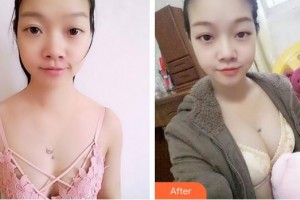 成都美容整形醫(yī)院劉來新整形價(jià)格表附濃縮豐胸真實(shí)案例展示