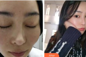 成都艾尚醫(yī)學(xué)美容門診部張桂林整形價(jià)格表附祛斑案例展示