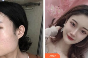 成都艾尚醫(yī)學(xué)美容門診部高亮整形價(jià)格表附下頜角整形案例展示