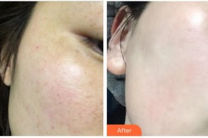 成都艾尚醫(yī)學(xué)美容門診部傅曉蓉整形價(jià)格表附光子嫩膚祛色斑案例展示