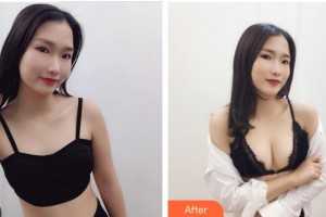 成都華顏醫(yī)療美容門診部王平整形價(jià)格表附濃縮豐胸真實(shí)案例展示