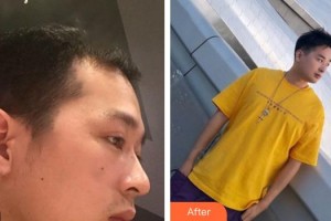 成都風(fēng)尚格致醫(yī)學(xué)美容整形醫(yī)院余正倫副教授 整形價(jià)格表附發(fā)際線案例展示