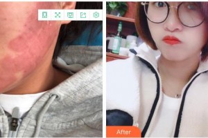 成都美極醫(yī)療美容門診部黃華整形價(jià)格表附點(diǎn)陣祛痘坑痘印案例展示