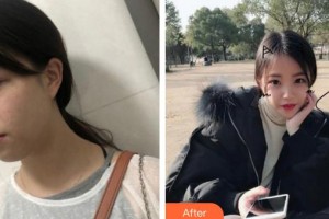 成都美立方（原華博）醫(yī)療美容醫(yī)院費(fèi)曉紅整形價(jià)格表附超激光美膚激光案例展示