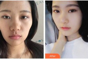 成都艾美醫(yī)療美容門診部蔣學(xué)江整形價(jià)格表附抗衰老—緊致祛皺—熱瑪吉案例展示